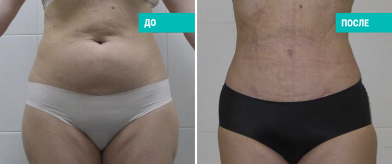 До и после липосакции. Пластический хирург А. А. Михайлов