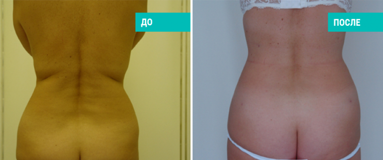До и после липосакции. Пластический хирург Т. А. Иванченкова