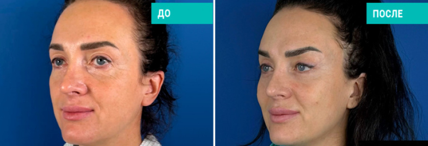 Комплексное омоложение