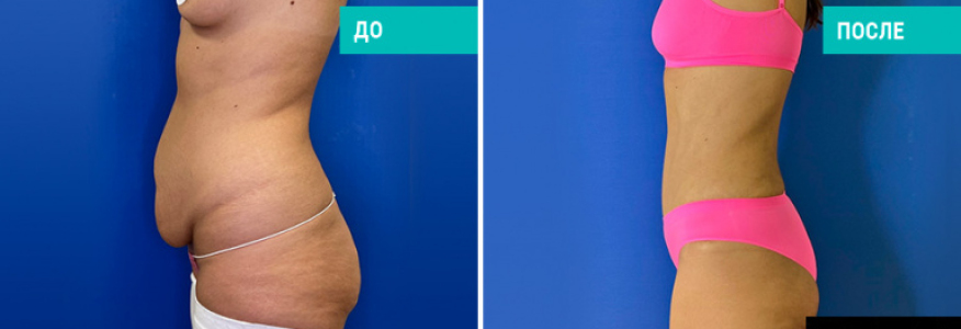 Липоабдоминопластика через 1,5 месяца