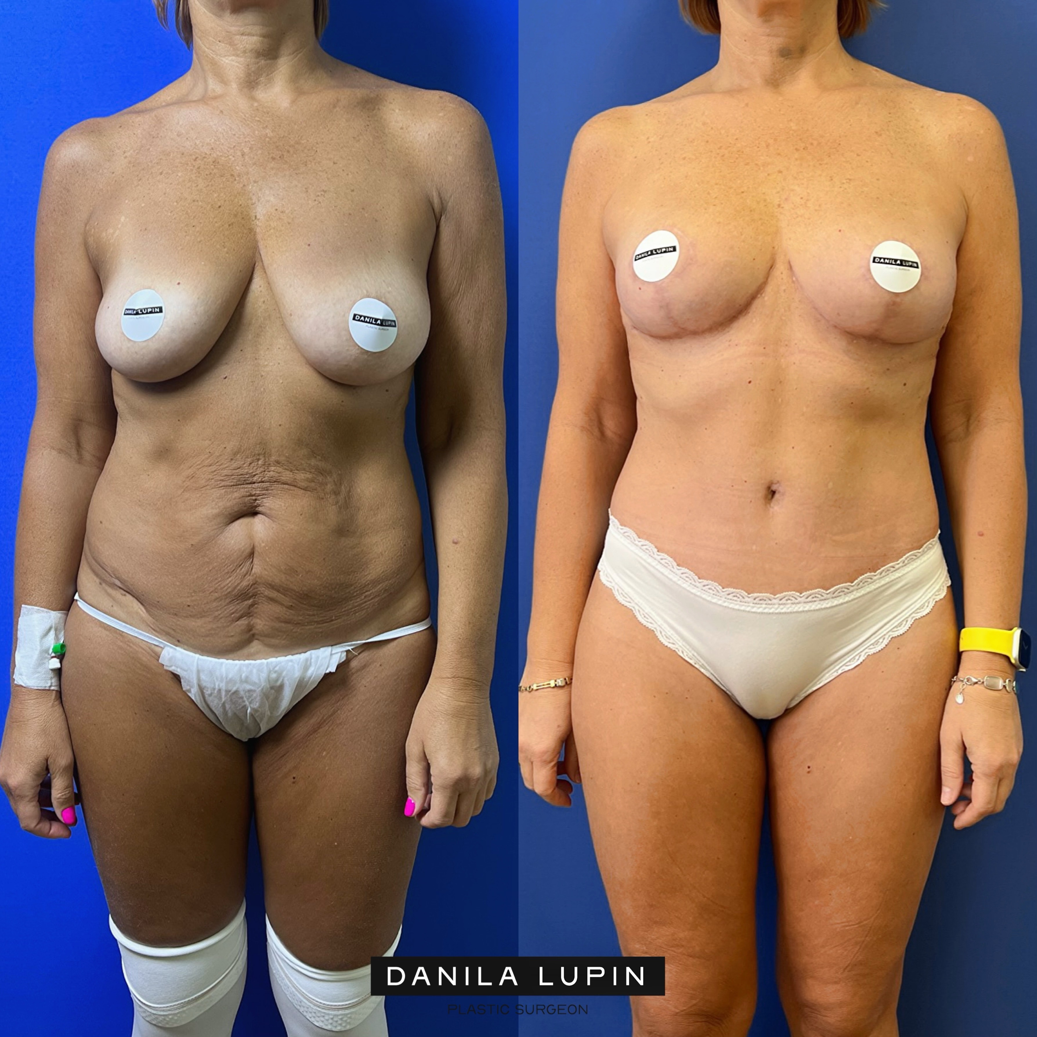 Выполнены бодилифт, подтяжка груди без имплантов, липофилинг ягодиц. Пластический хирург Д. А. Лупин