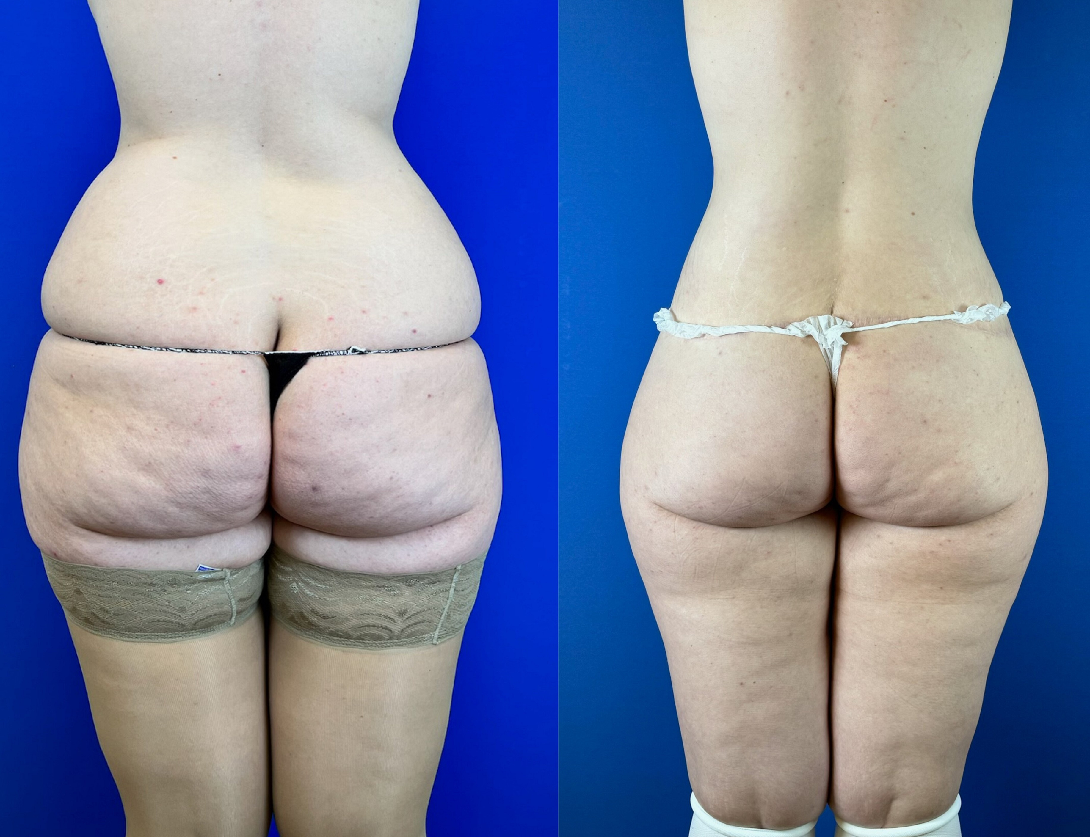 Выполнен нижний бодилифт (через год после операции). Пластический хирург Д. А. Лупин