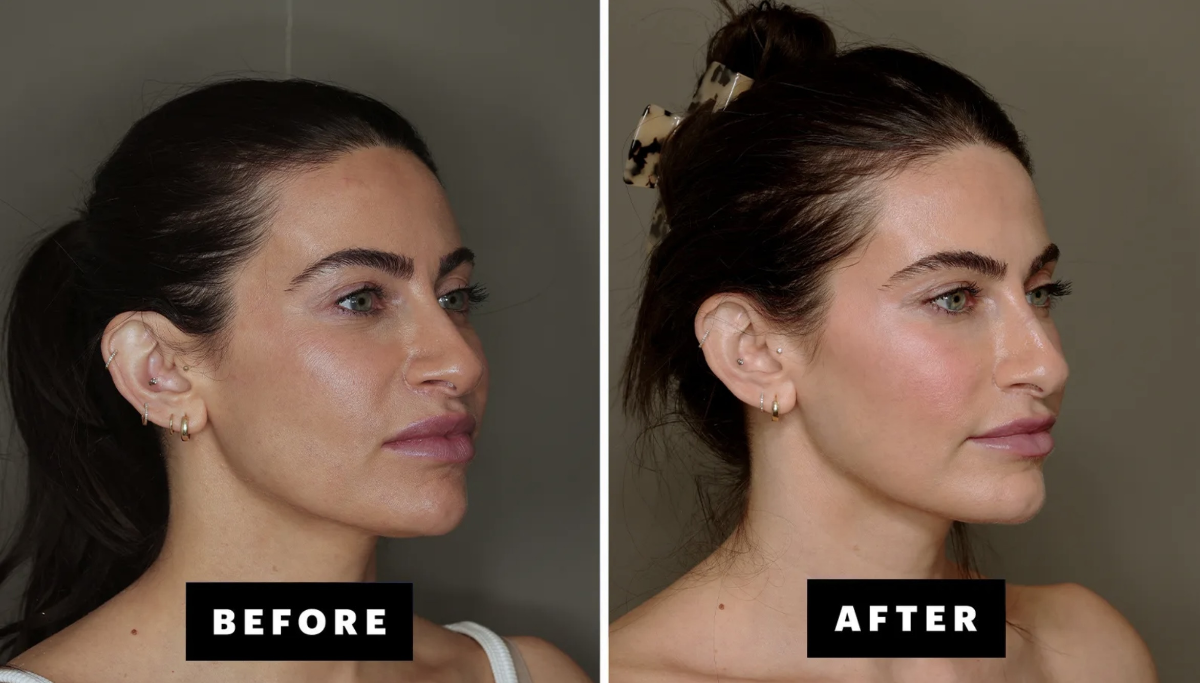 Фото: до и после липофилинга