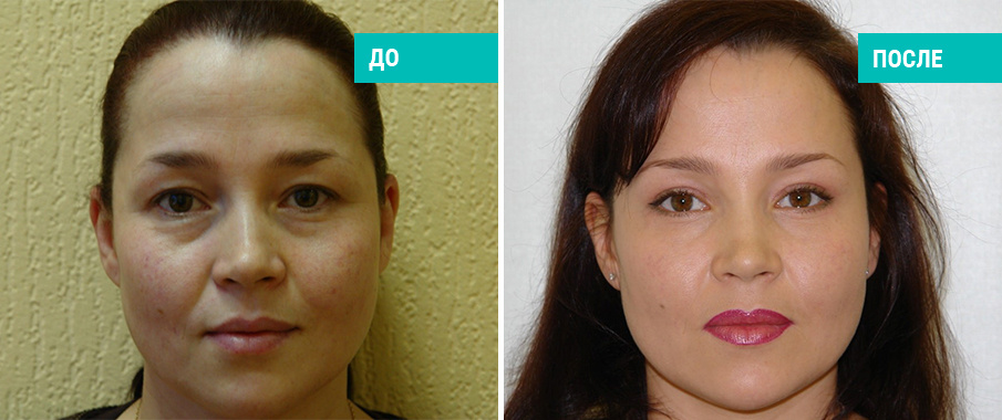 До и после блефаропластики. Пластический хирург В. Г. Якимец