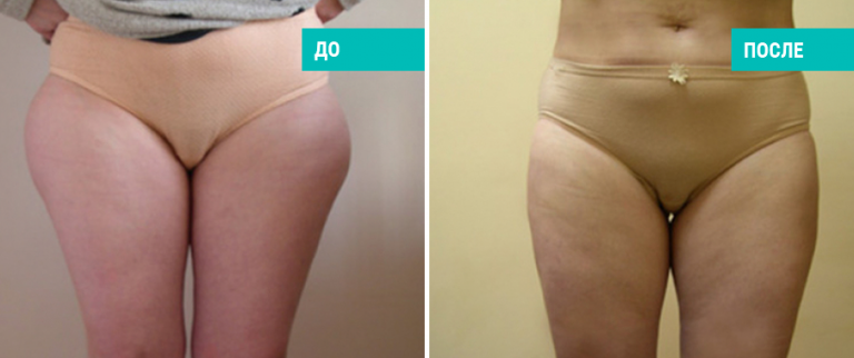 До и после липосакции. Пластический хирург Т. А. Иванченкова