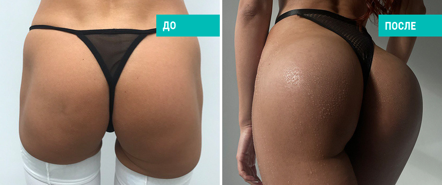 До и после глютеопластики. Пластический хирург Д. В. Крысин