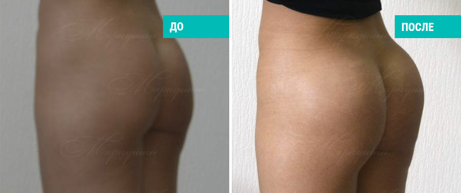 До и после глютеопластики. Пластический хирург А. А. Маркушин