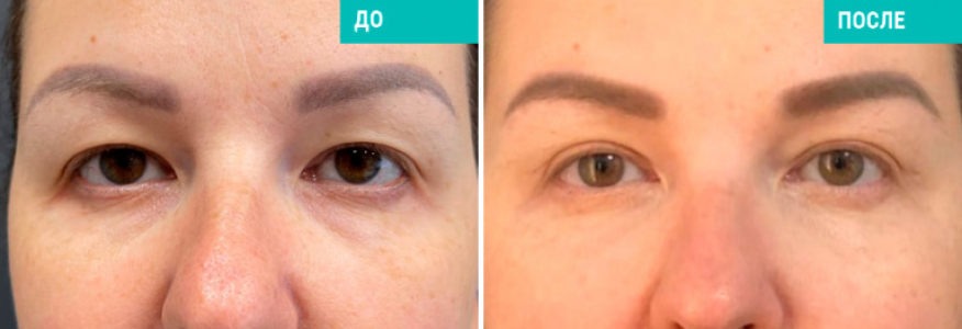 Блефаропластика