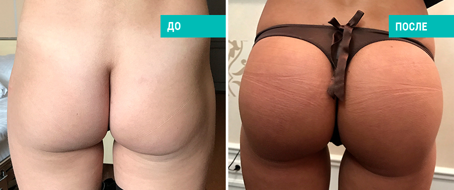 Пациентка Д. В. Крысина до и после пластики ягодиц
