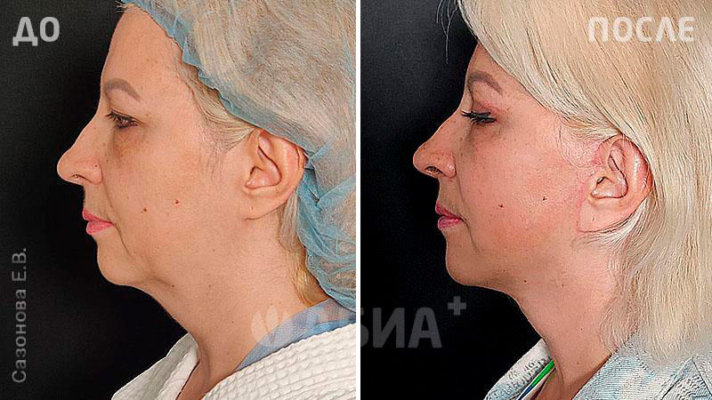 До и после пластики лица. Пациентка Е. В. Сазоновой