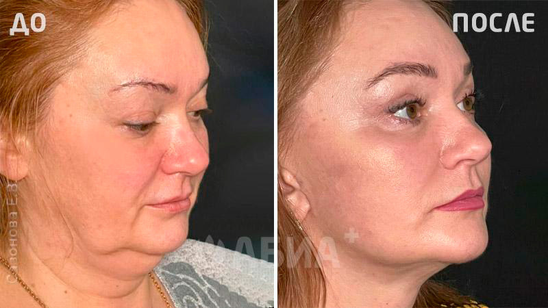 До и после пластики лица. Пациентка Е. В. Сазоновой