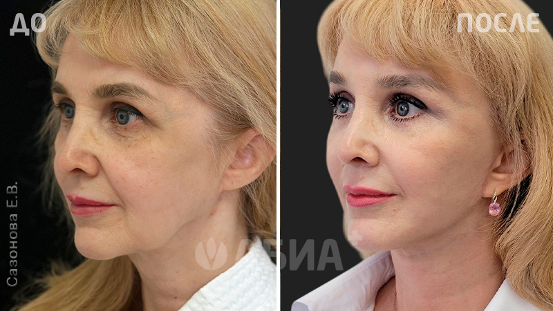 До и после фейслифтинга. Пациентка Е. В. Сазоновой