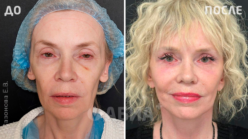 До и после пластики лица. Пациентка Е. В. Сазоновой