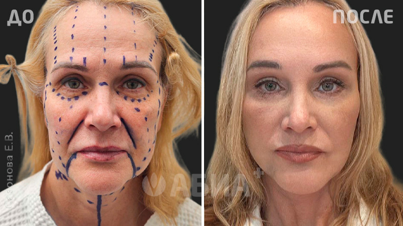 До и после пластики лица. Пациентка Е. В. Сазоновой