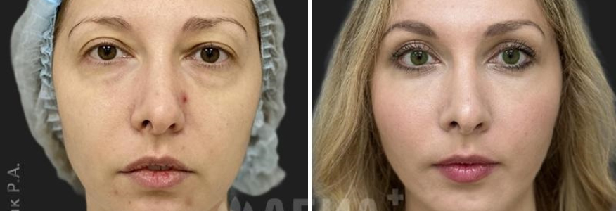 Пластика лица