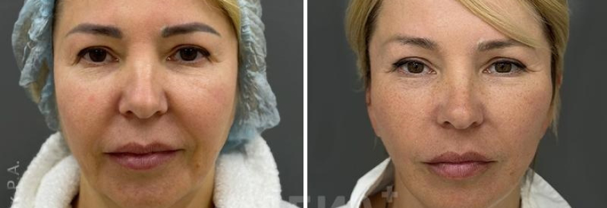 Пластика лица