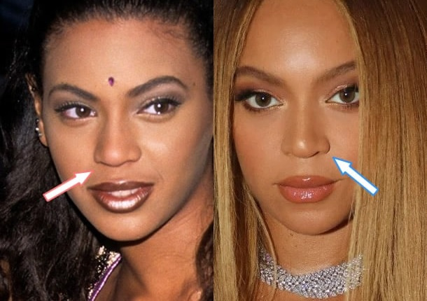 Ринопластика Бейонсе