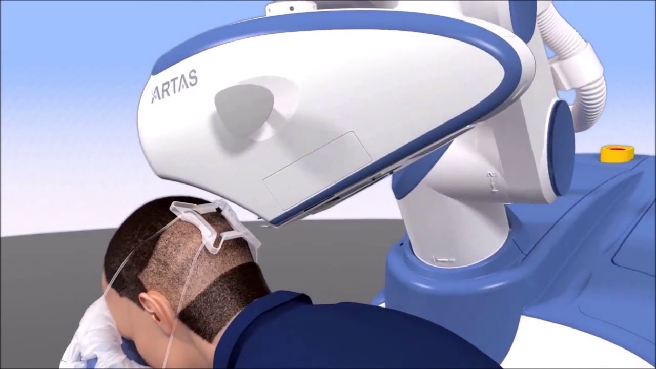 Фото: Робот для трансплантации волос ATRAS