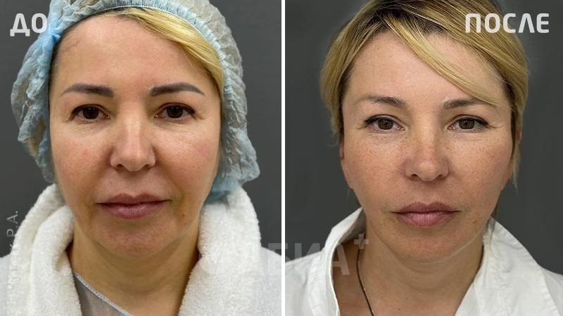 Фото до и после подтяжки лица. Пластический хирург Чумак Р. А.