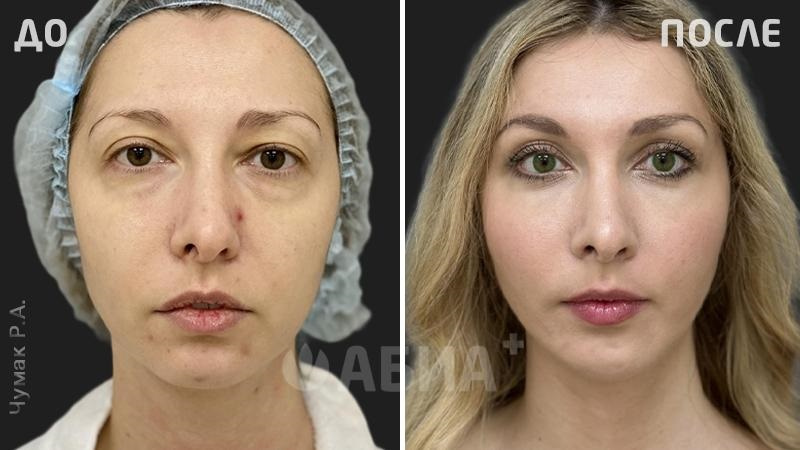 Фото до и после эндоскопической подтяжки лица. Пластический хирург Чумак Р. А.