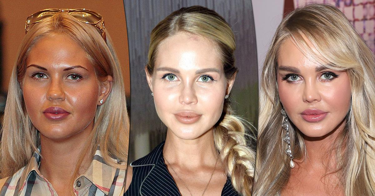 Мария Погребняк до и после пластики