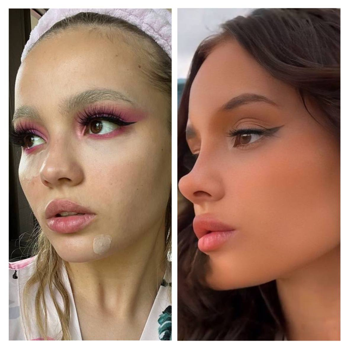 Валя Карнавал до и после пластики носа