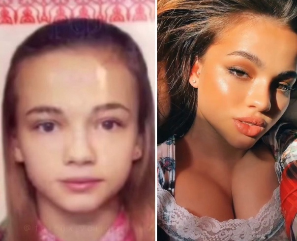 Валя Карнавал до и после увеличения губ