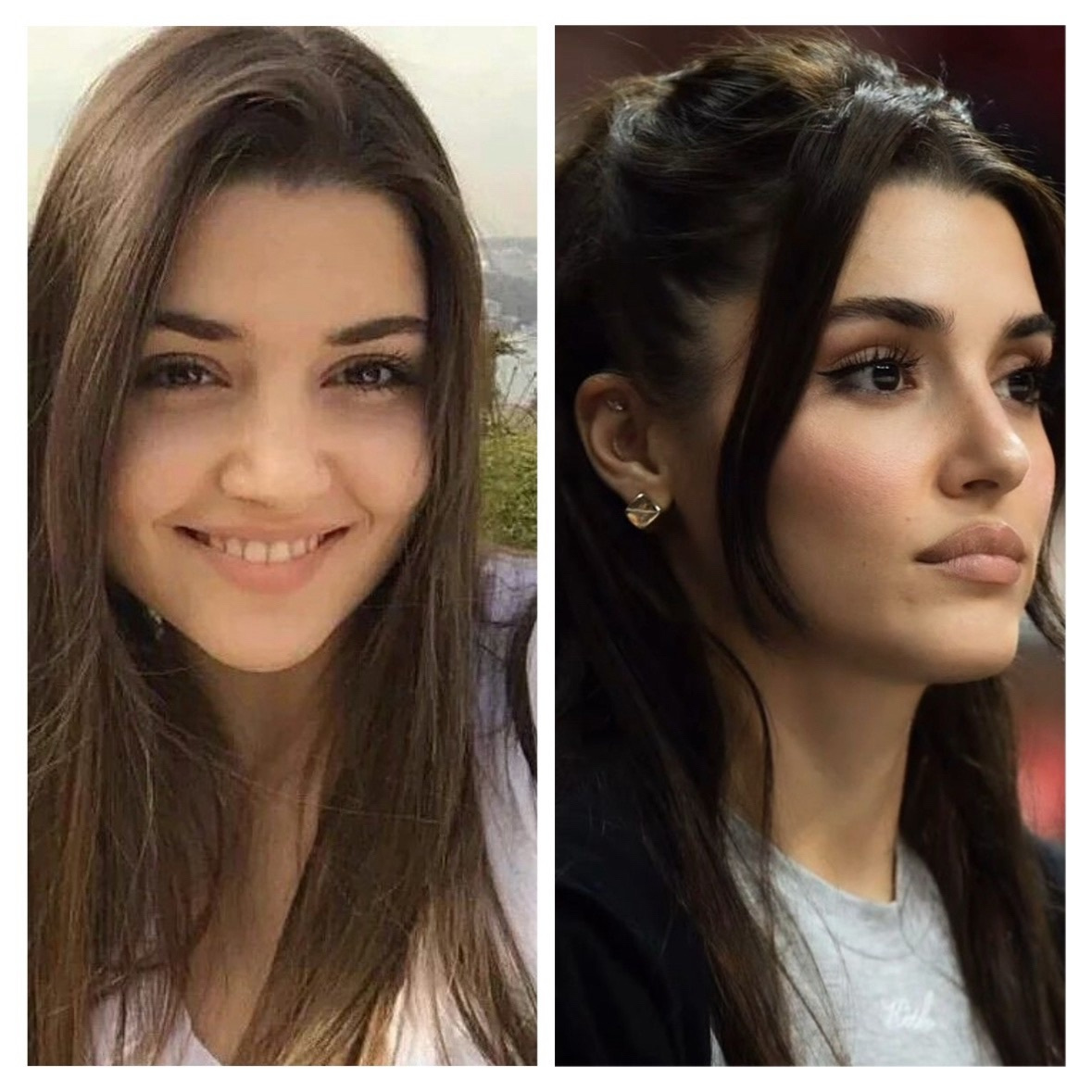 Ханде Эрчел до и после пластики носа