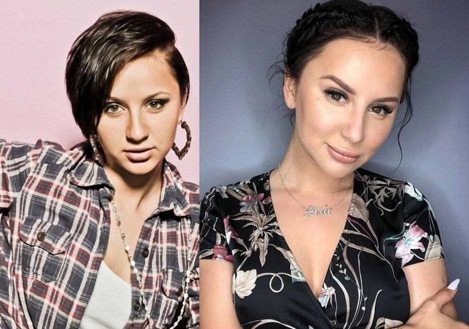 Анна Дзюба до и после пластики носа