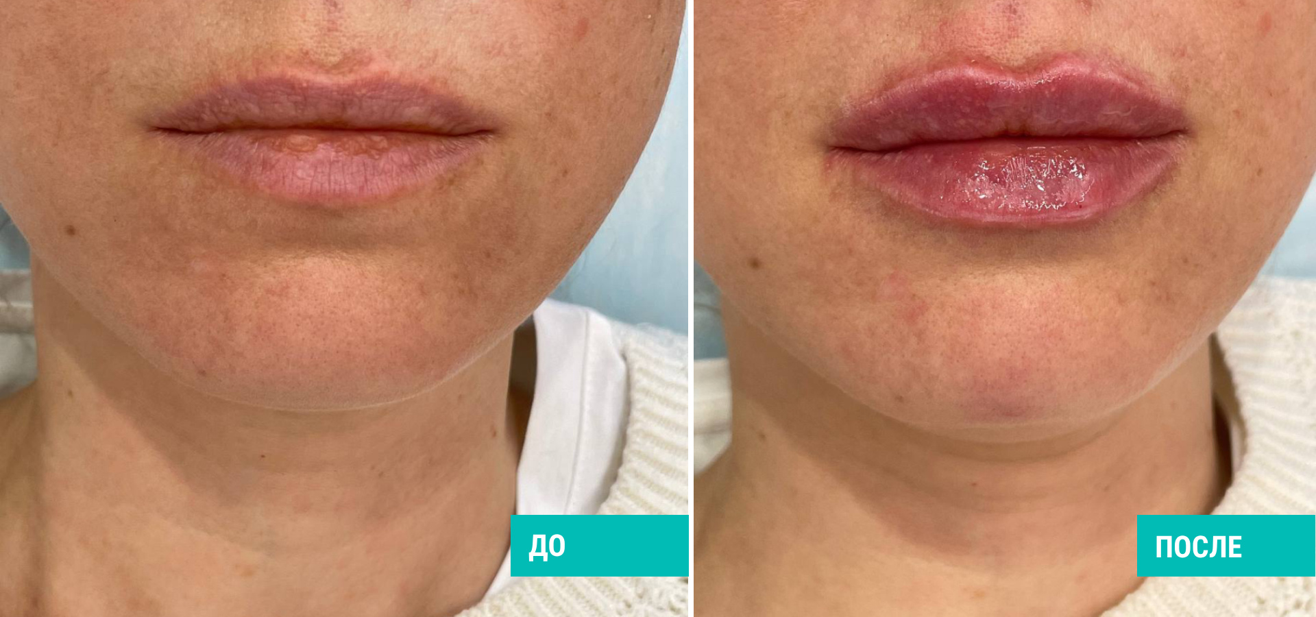 До и после контурной пастики губ. Пациентка Д. О. Аёзова