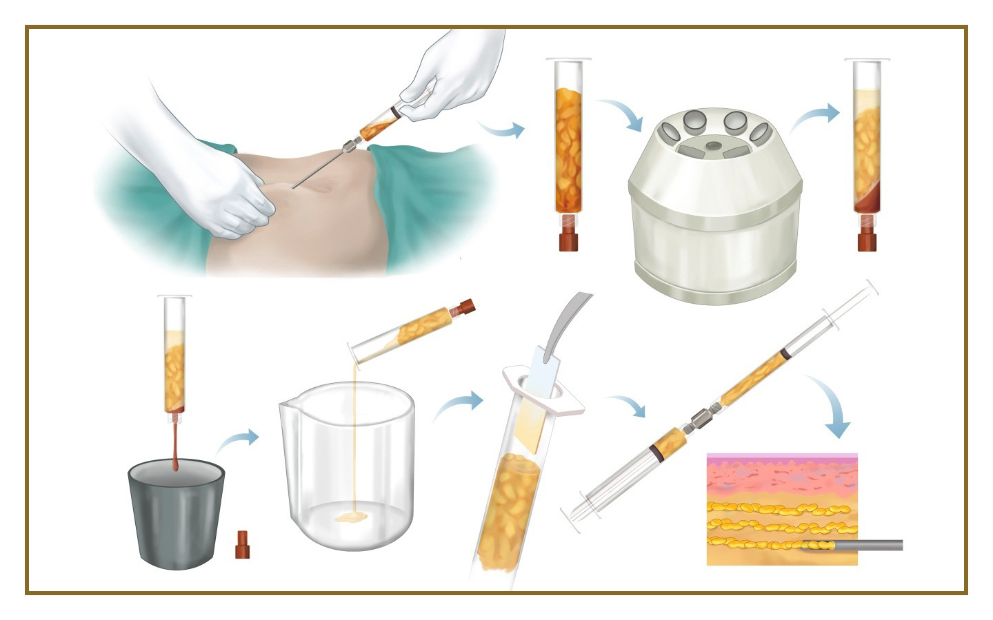 Фото: процедура липофилинга