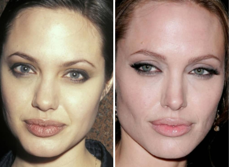 Анджелина Джоли до и после пластики носа