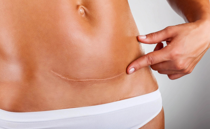 Современные методы коррекции рубцов