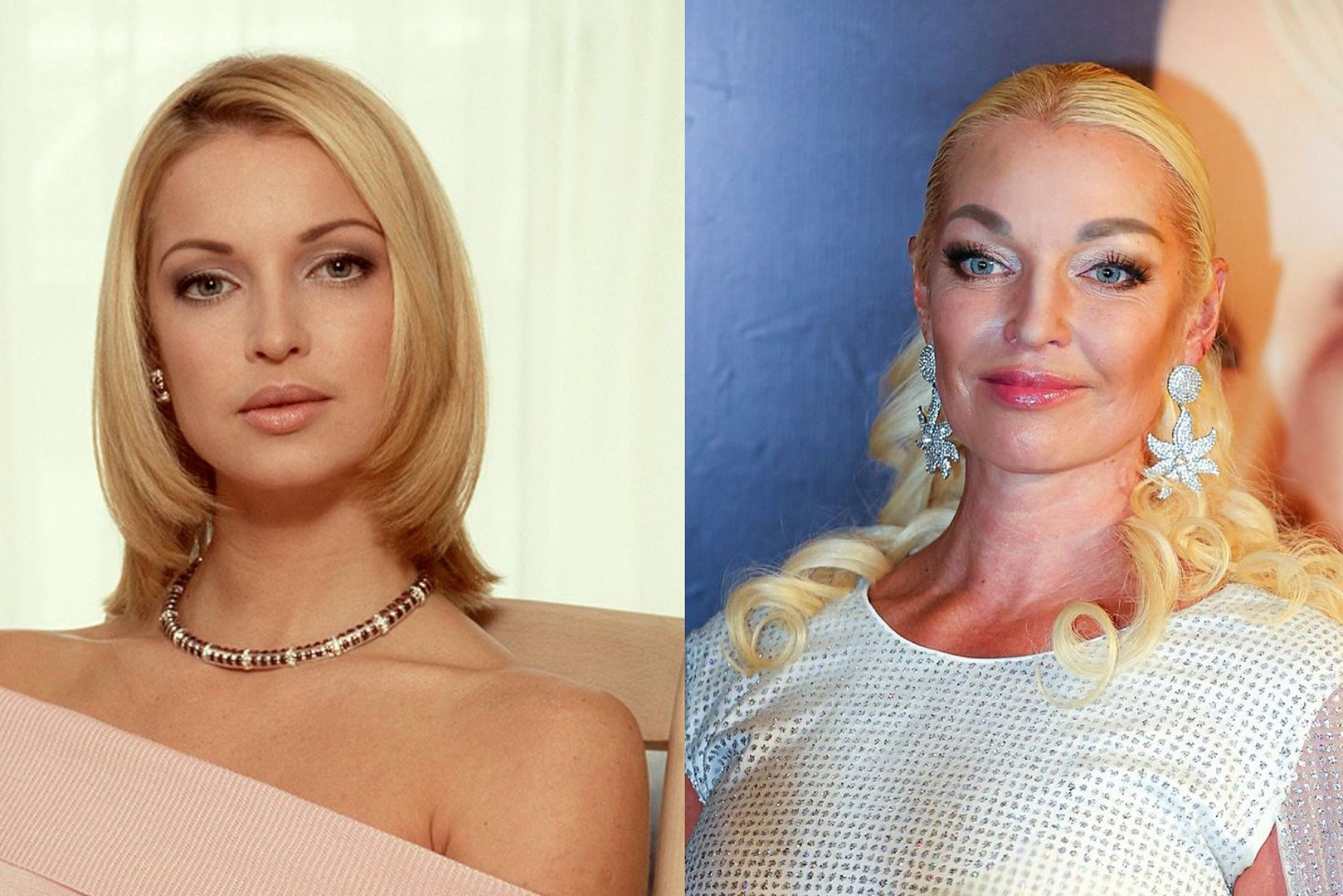 Анастасия Волочкова до и после пластики