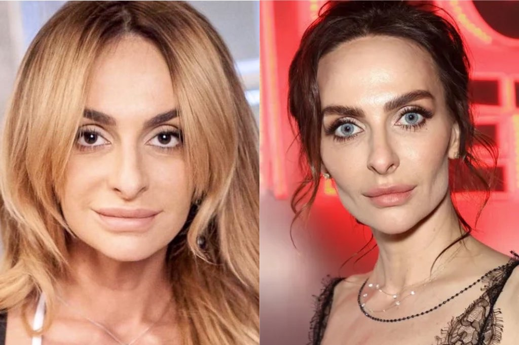 Екатерина Варнава до и после пластики