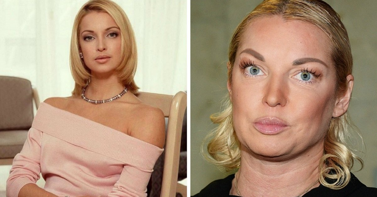 Анастасия Волочкова до и после пластики