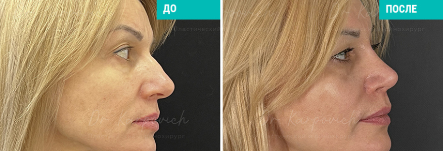 Ринопластика