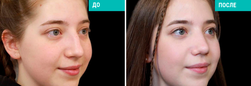 Риносептопластика