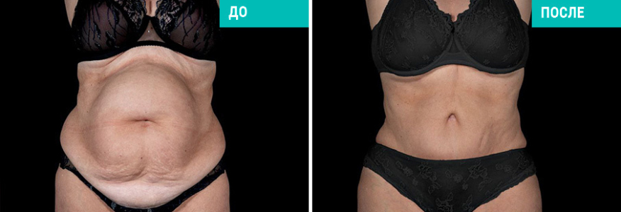 Абдоминопластика