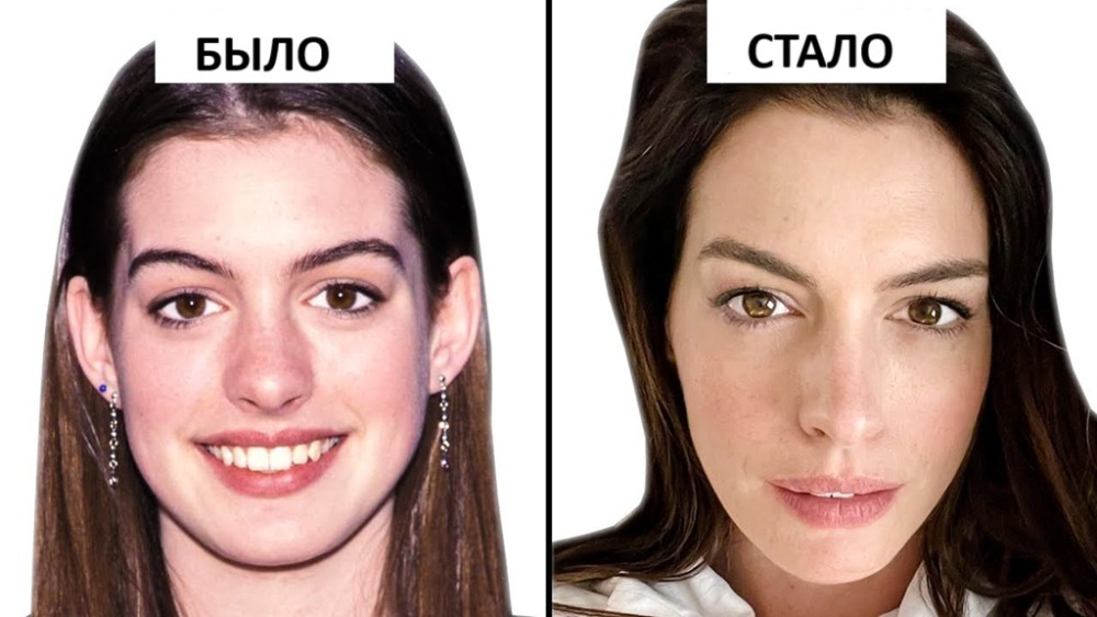 Энн Хэтэуэй до и после блефаропластики