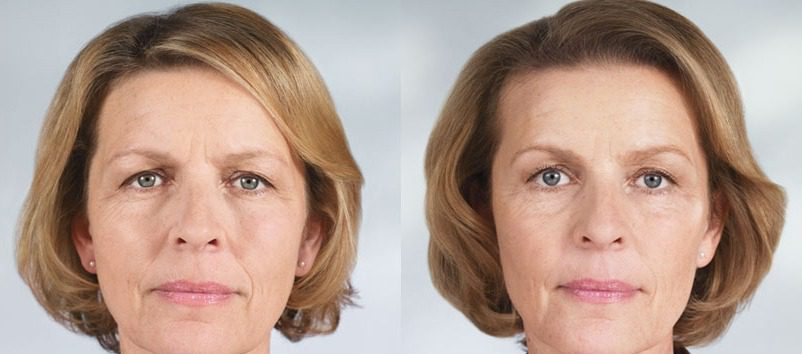 До и после тейпирования лица