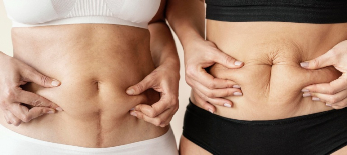 Абдоминопластика: чудо-преображение после родов