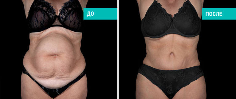 До и после абдоминопластики. Пластический хирург Д. В. Пахилин