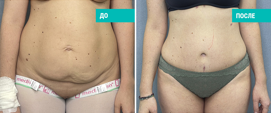 До и после абдоминопластики. Пластический хирург Зимин Д. А.
