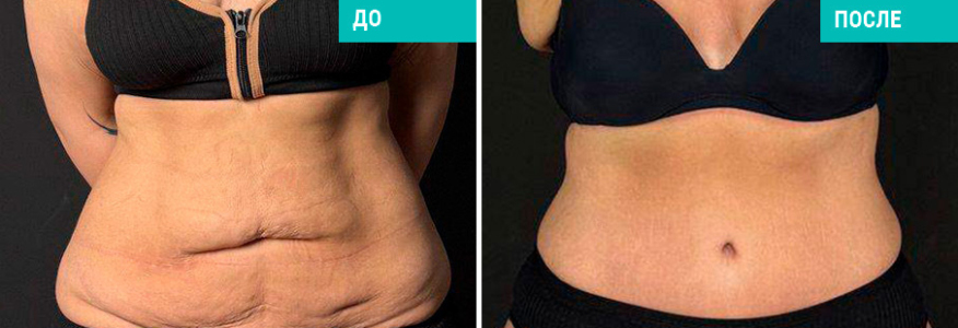 Абдоминопластика