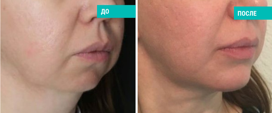 До и после ментопластики. Пластический хирург Гауэр Л.Н.