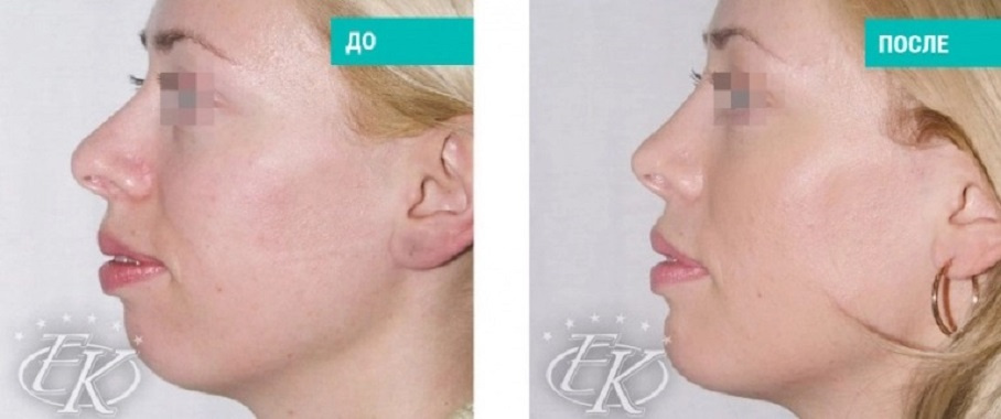 До и после ментопластики. Пластический хирург Кудинова Е.С.