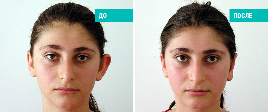 Отопластика: до и после. Хирург: Г.П.Бабаян