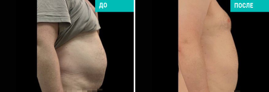 Липосакция