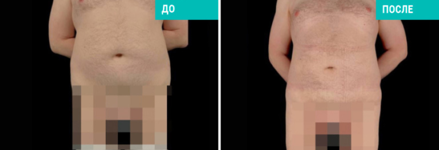 Липосакция